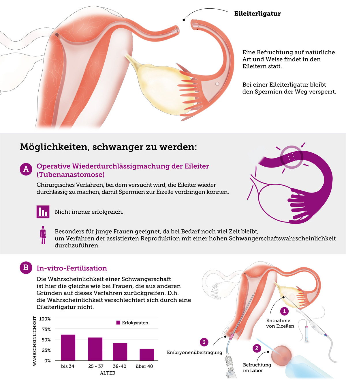 Eine Schwangerschaft nach einer Eileiterligatur ist möglich