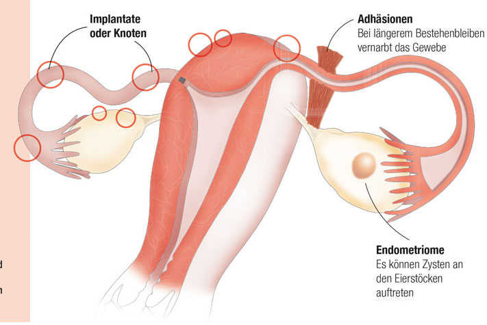 Wie wirkt sich Endometriose auf Ihre Fruchtbarkeit aus?